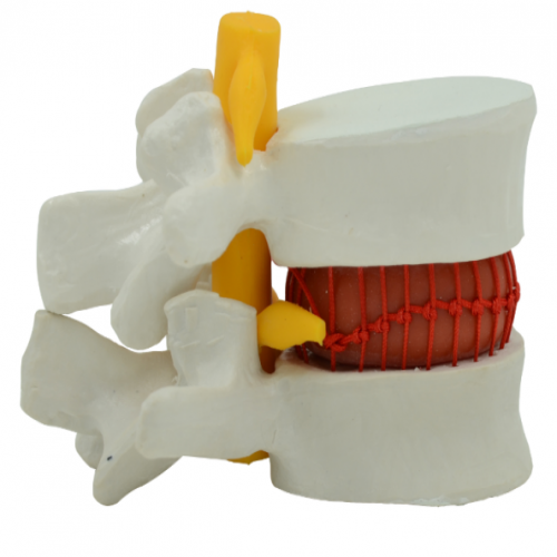 椎間盤突出模型（動態演示）